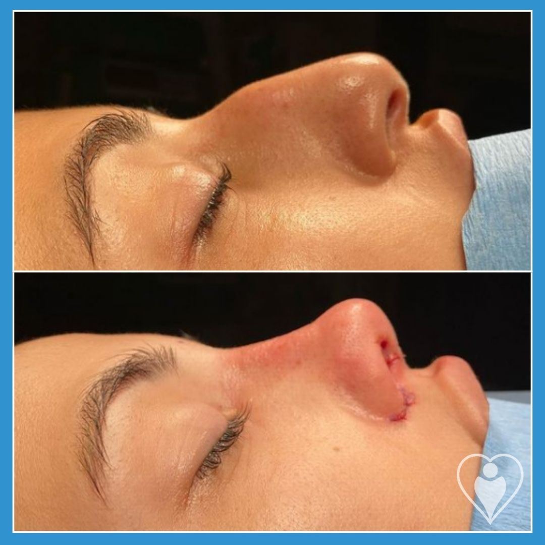 Rhinoplasty, before and after, Luna Clinic Turkey