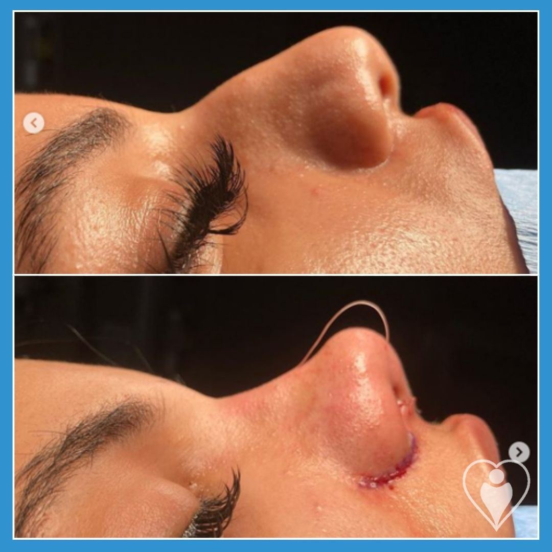 Rhinoplasty, before and after, Luna Clinic Turkey