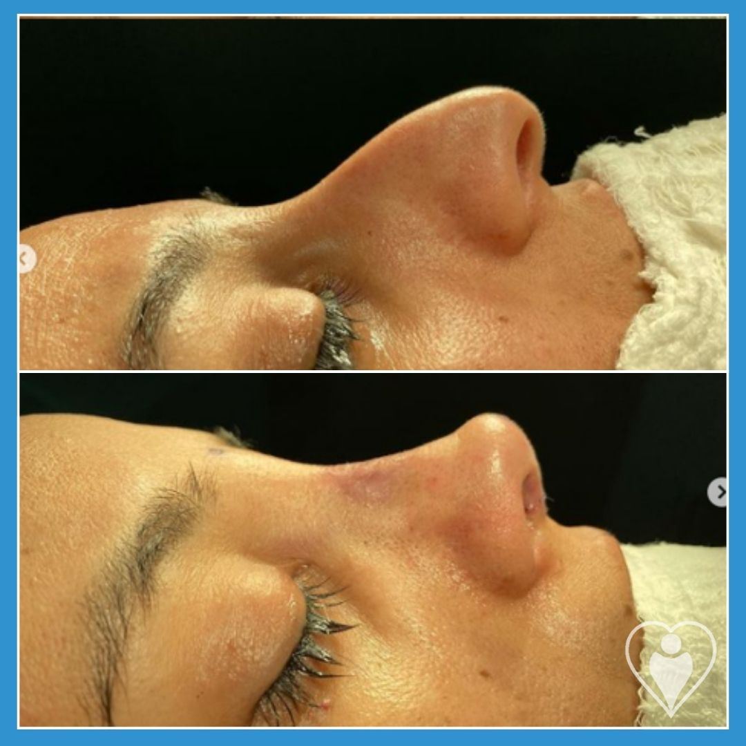 Rhinoplasty, before and after, Luna Clinic Turkey