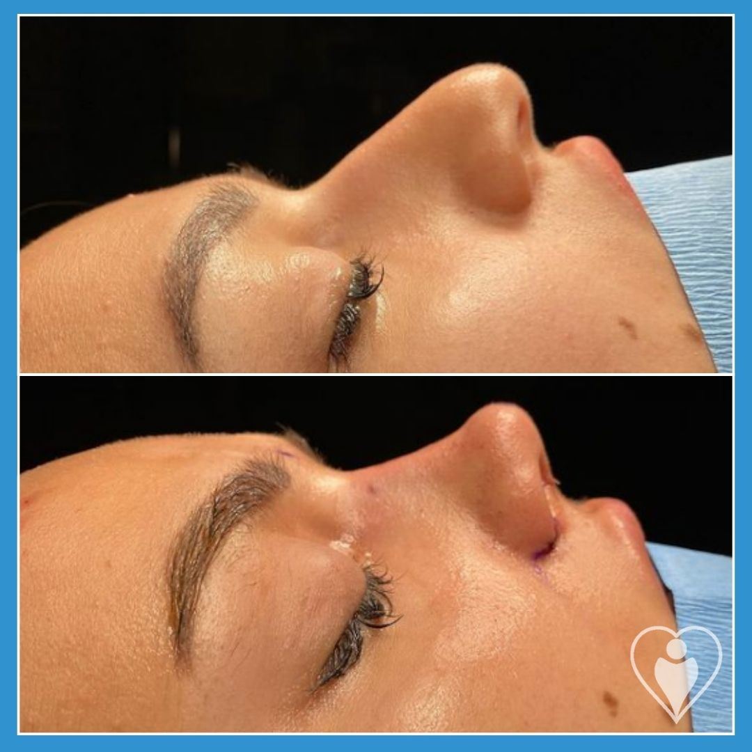 Rhinoplasty, before and after, Luna Clinic Turkey