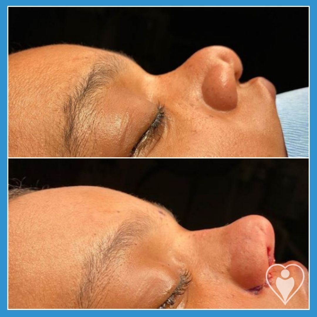 Rhinoplasty, before and after, Luna Clinic Turkey