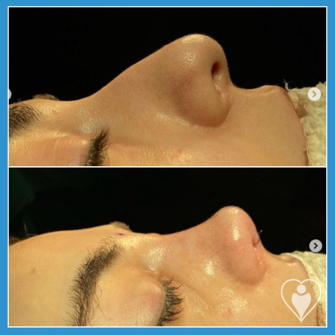 Rhinoplasty, before and after, Luna Clinic Turkey