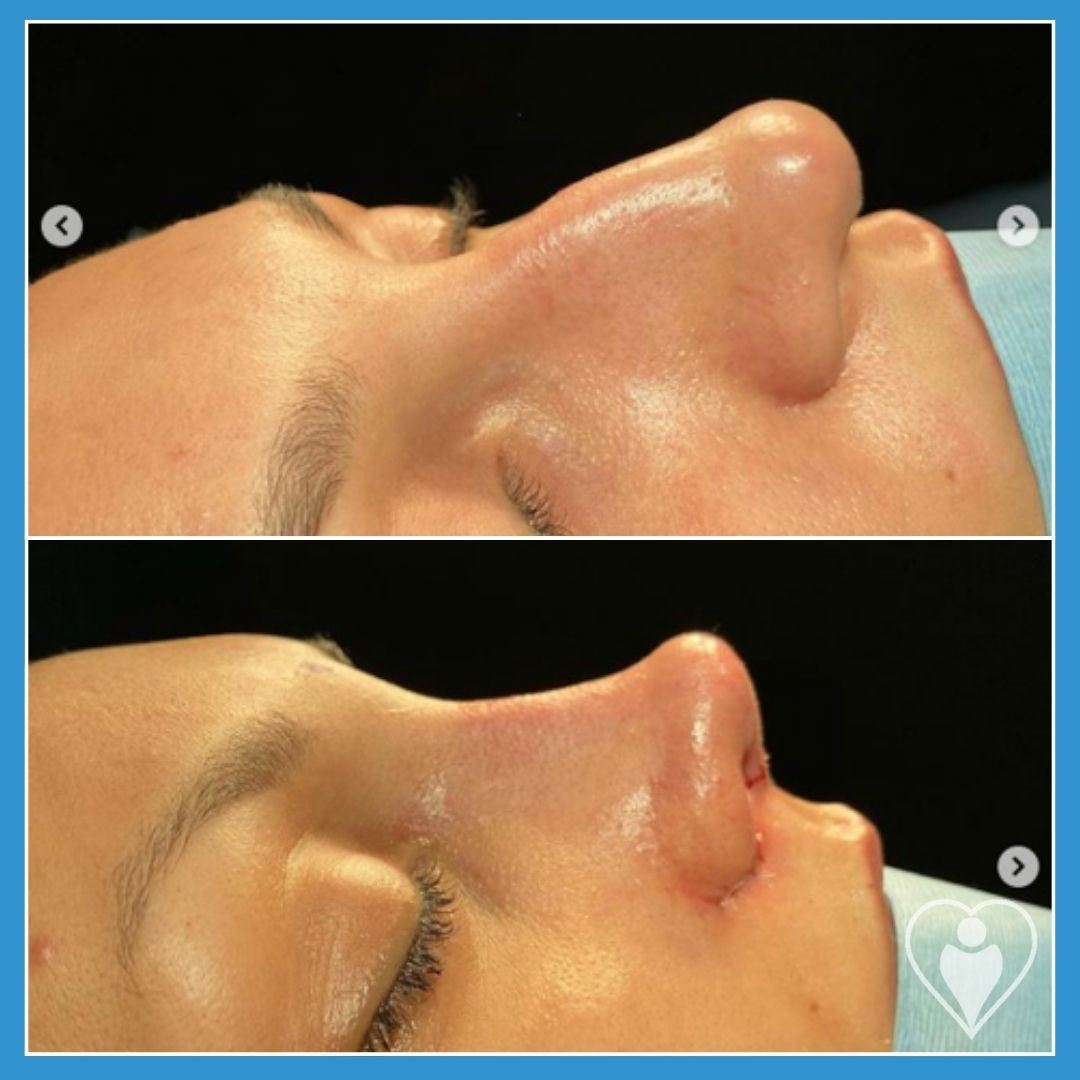 Rhinoplasty, before and after, Luna Clinic Turkey