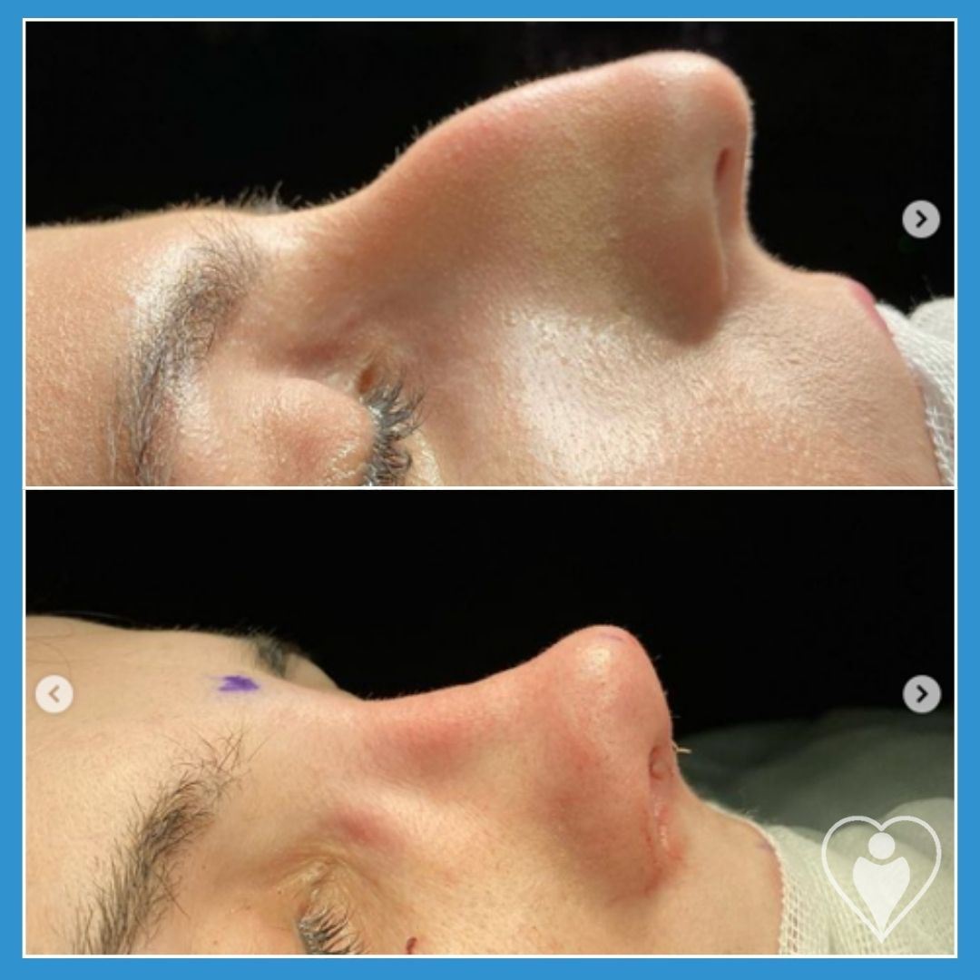 Rhinoplasty, before and after, Luna Clinic Turkey