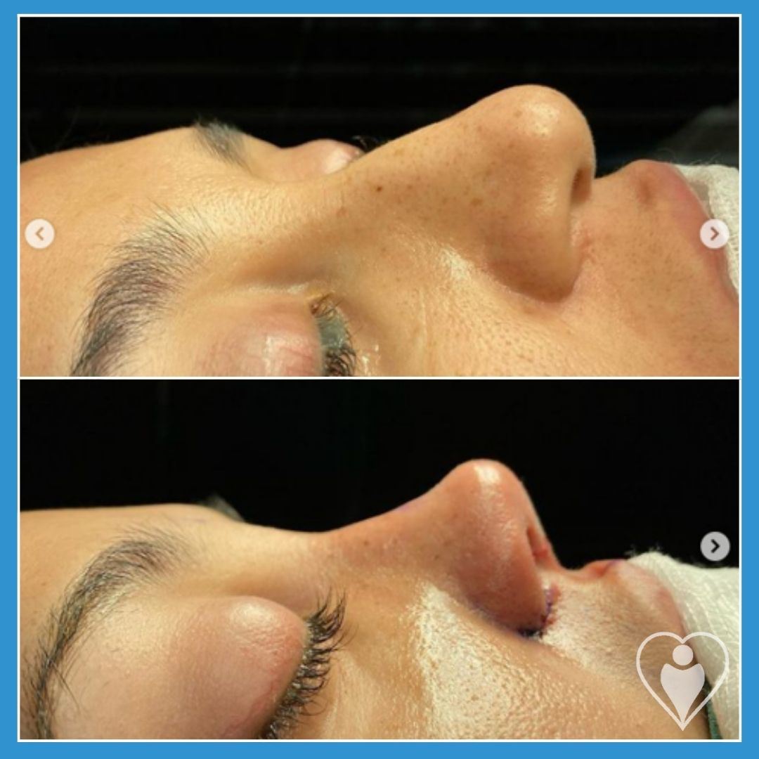 Rhinoplasty, before and after, Luna Clinic Turkey