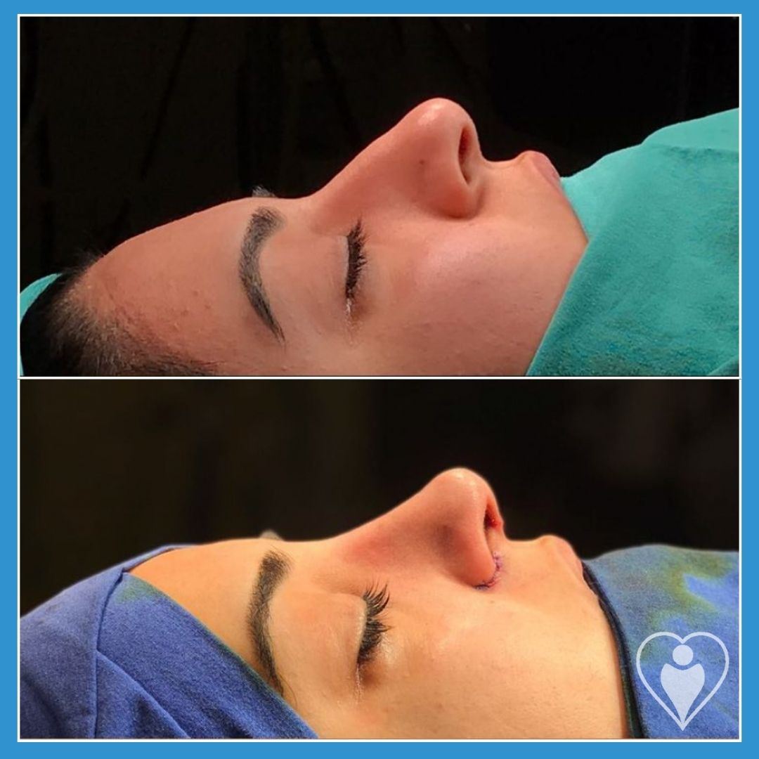 Rhinoplasty, before and after, Luna Clinic Turkey