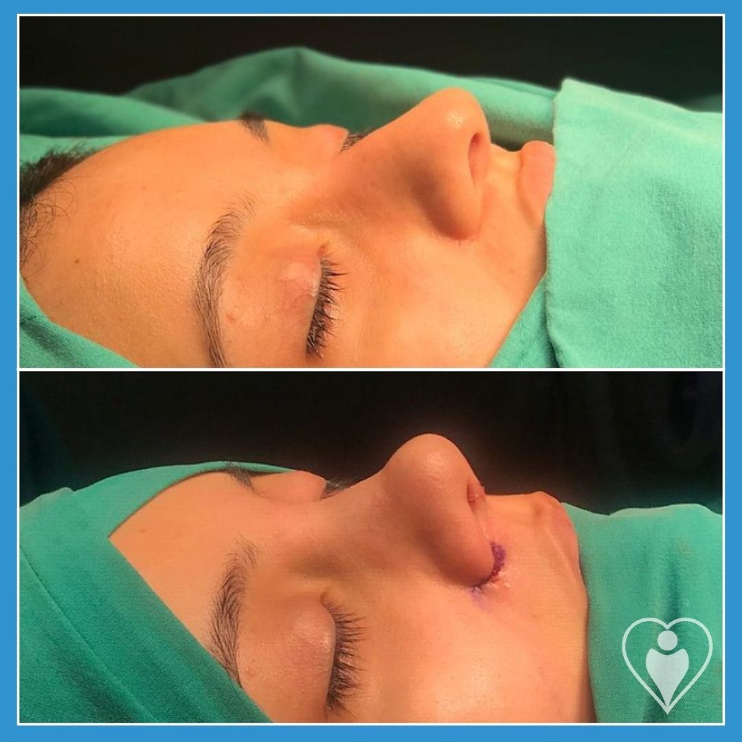 Rhinoplasty, before and after, Luna Clinic Turkey
