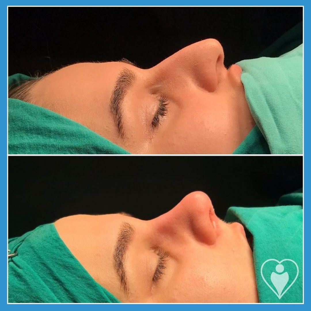 Rhinoplasty, before and after, Luna Clinic Turkey