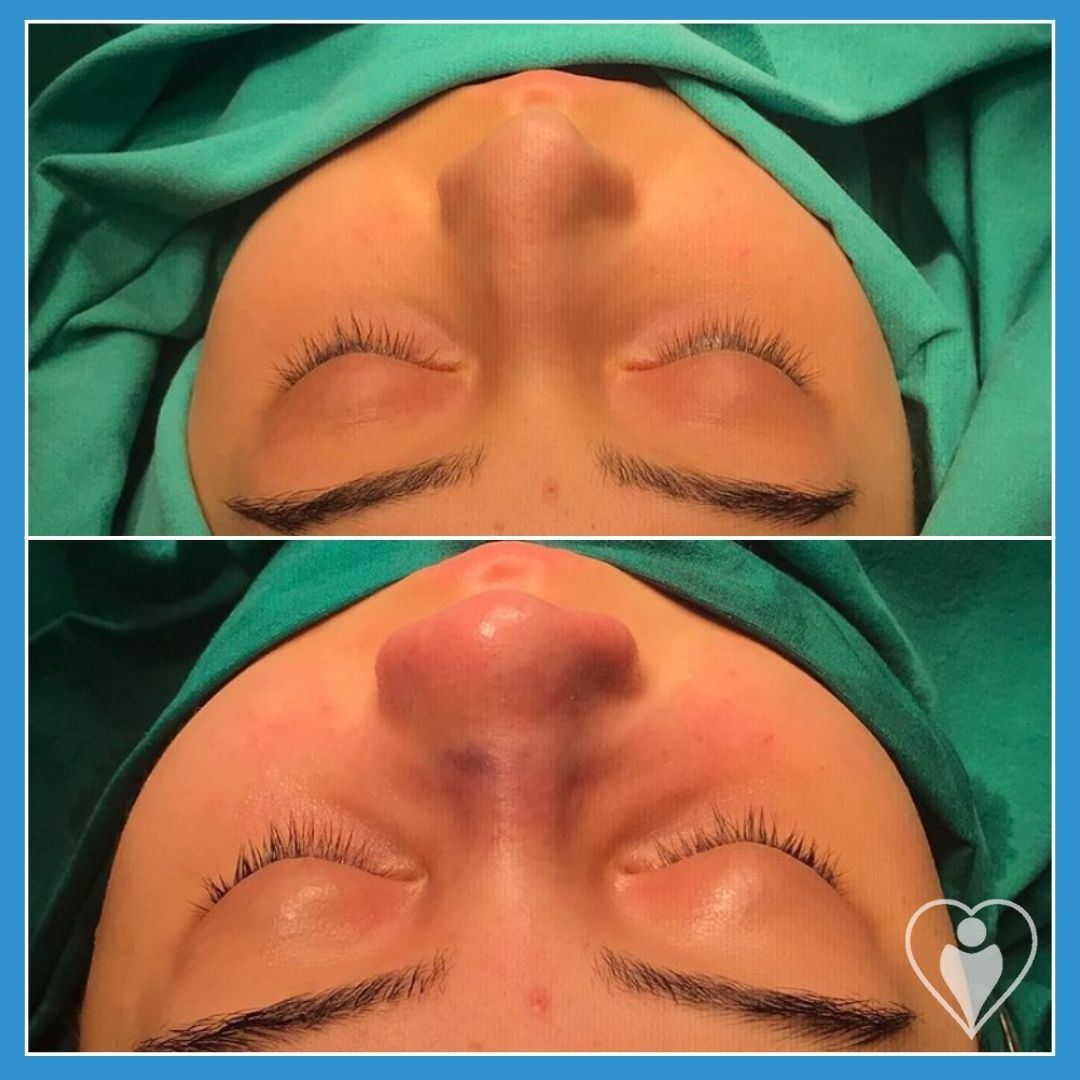 Rhinoplasty, before and after, Luna Clinic Turkey