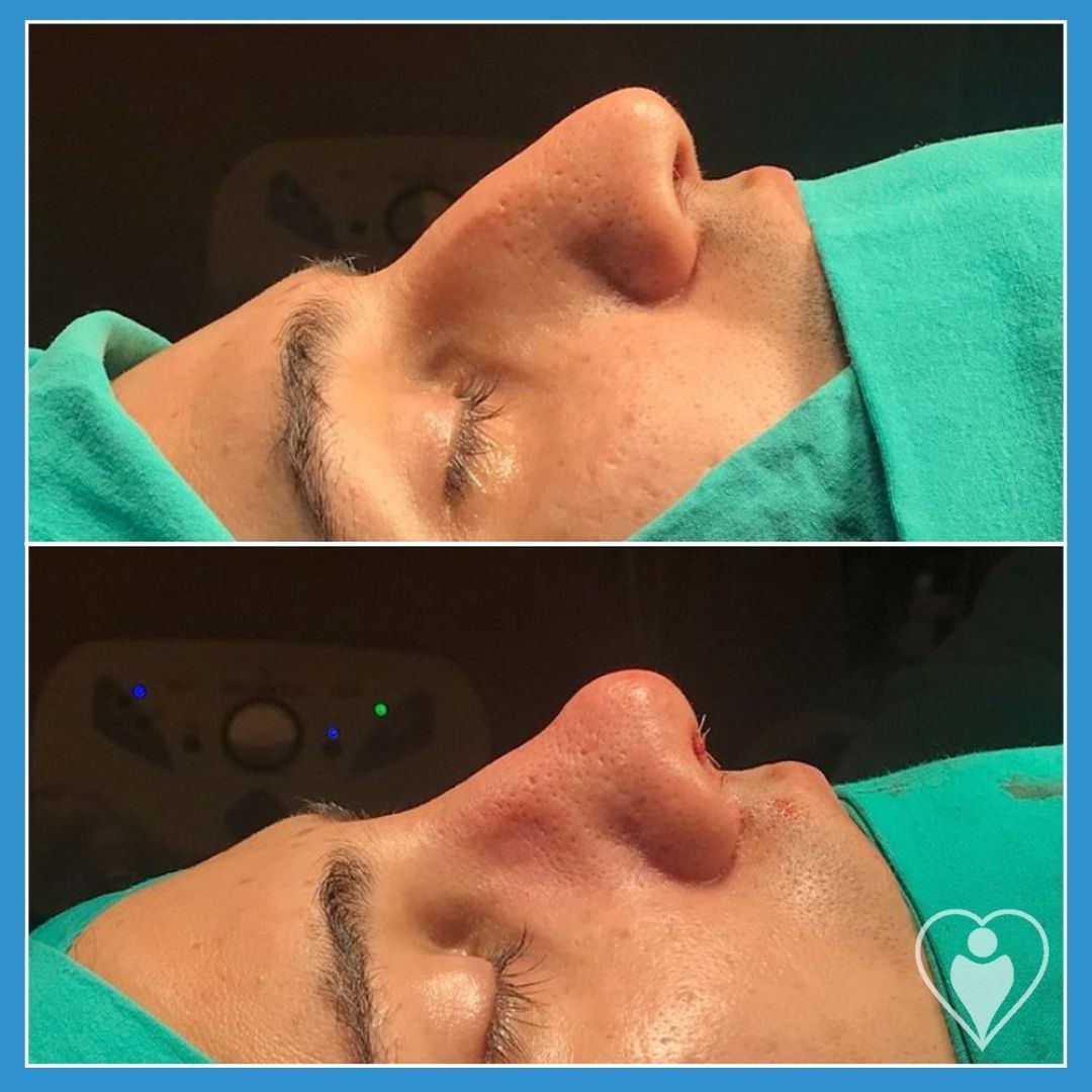Rhinoplasty, before and after, Luna Clinic Turkey