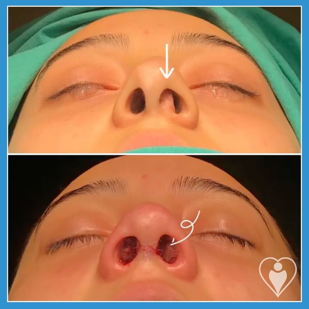 Rhinoplasty, before and after, Luna Clinic Turkey