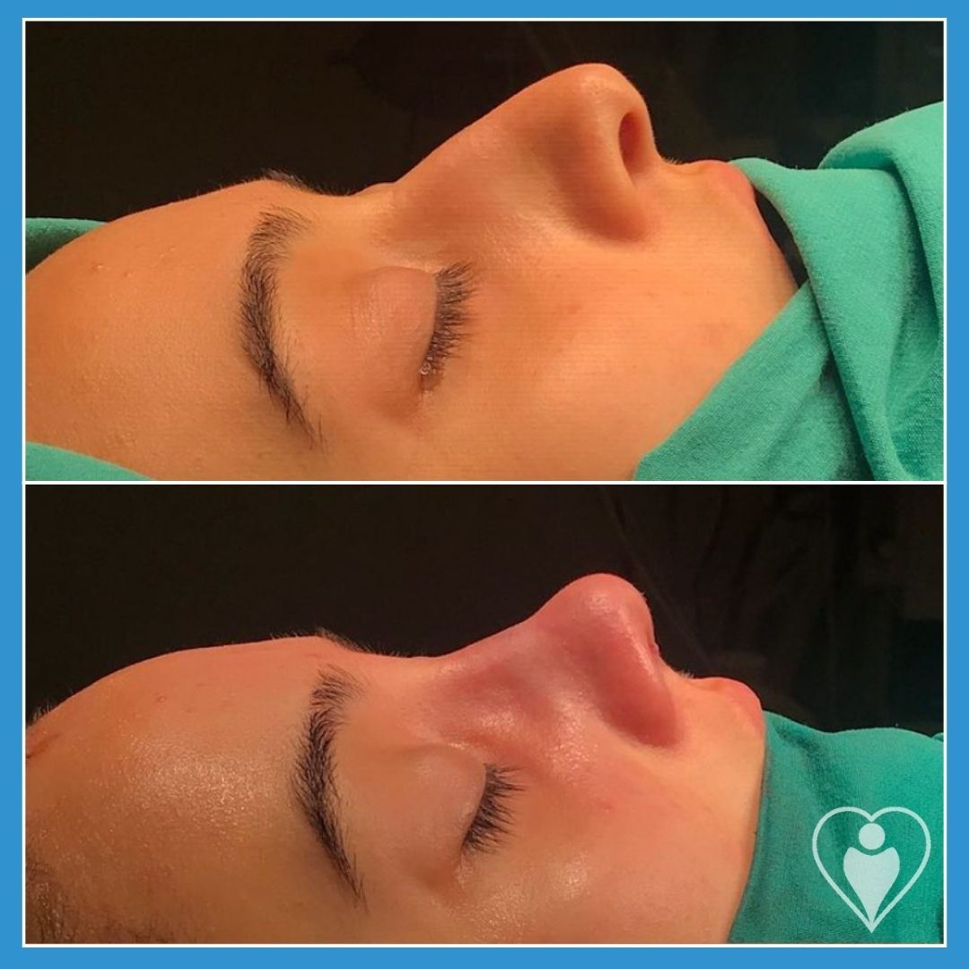 Rhinoplasty, before and after, Luna Clinic Turkey