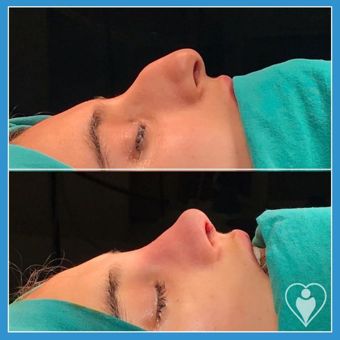 Rhinoplasty, before and after, Luna Clinic Turkey