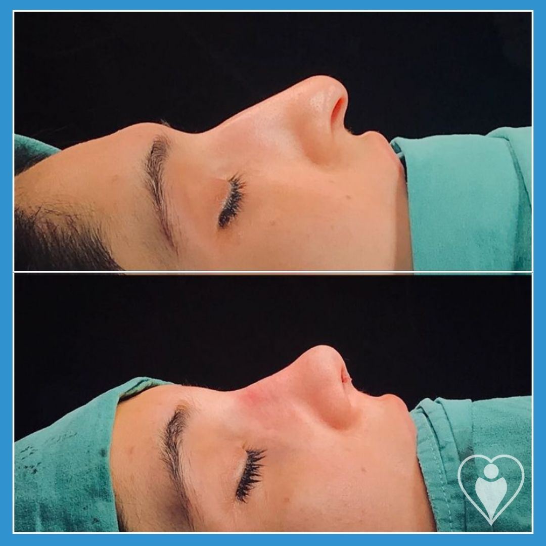 Rhinoplasty, before and after, Luna Clinic Turkey