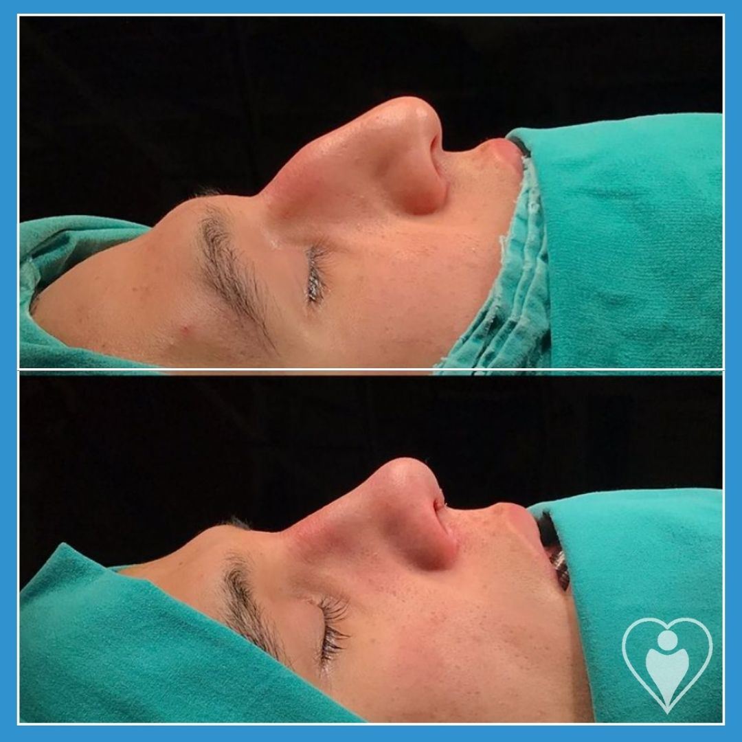 Rhinoplasty, before and after, Luna Clinic Turkey