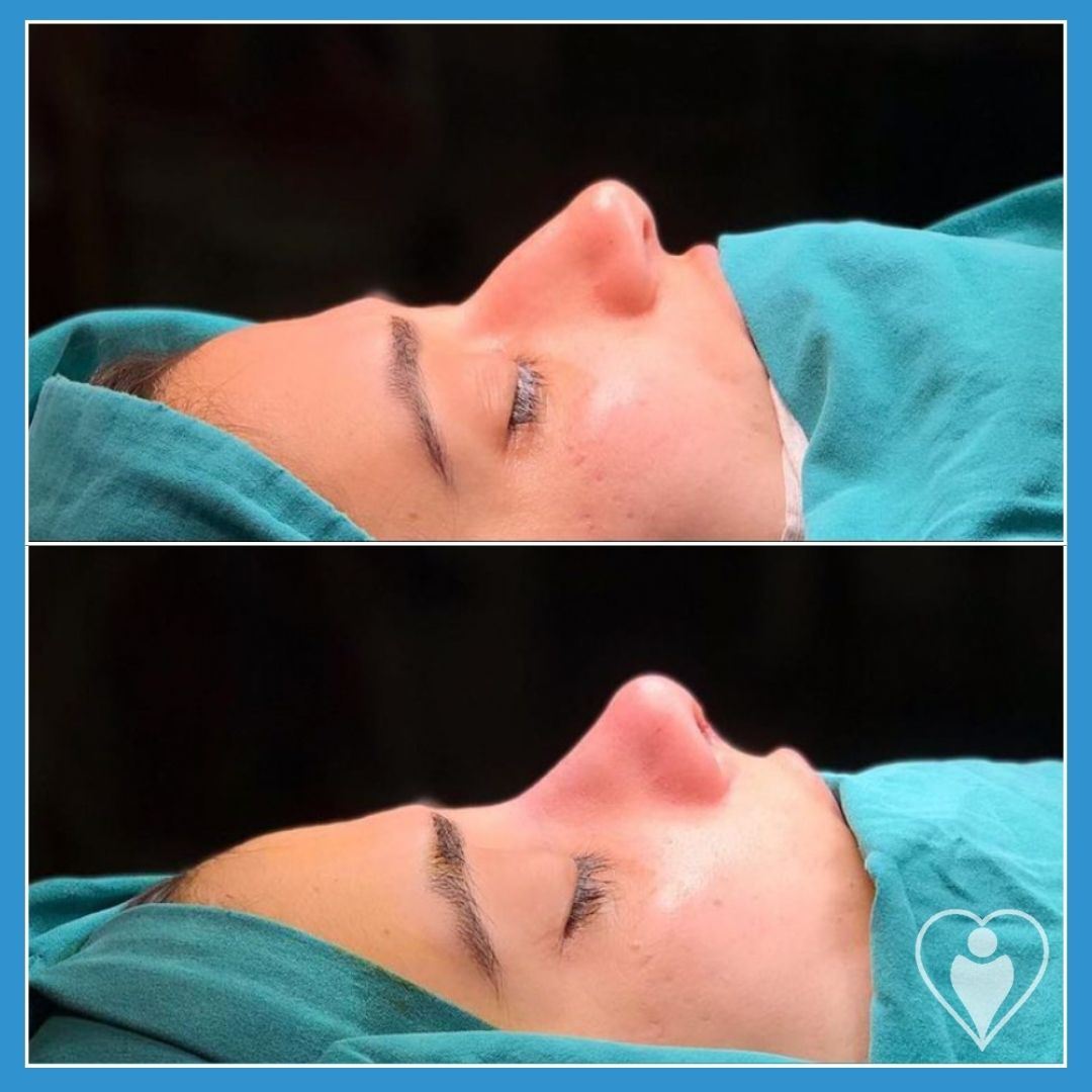 Rhinoplasty, before and after, Luna Clinic Turkey