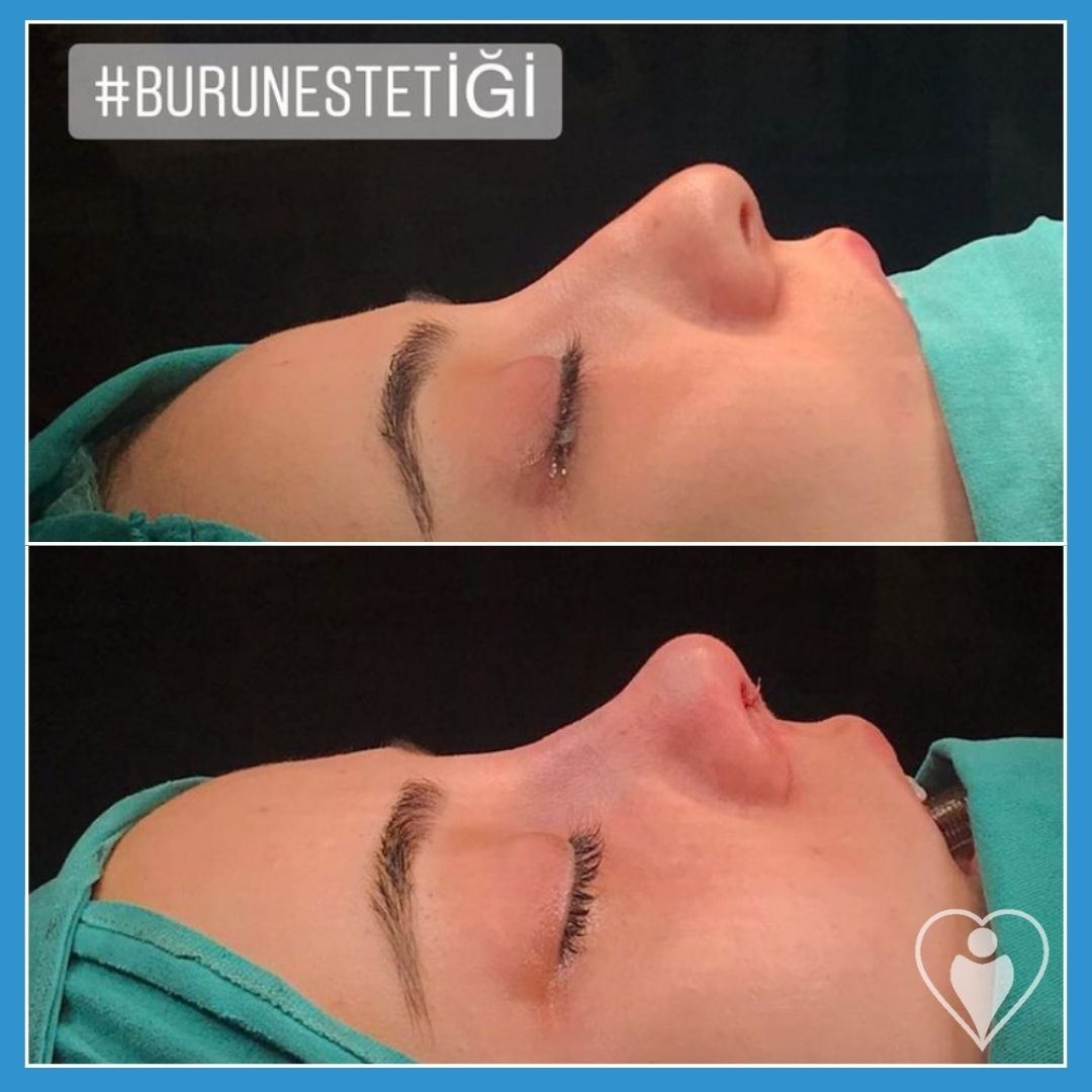 Rhinoplasty, before and after, Luna Clinic Turkey