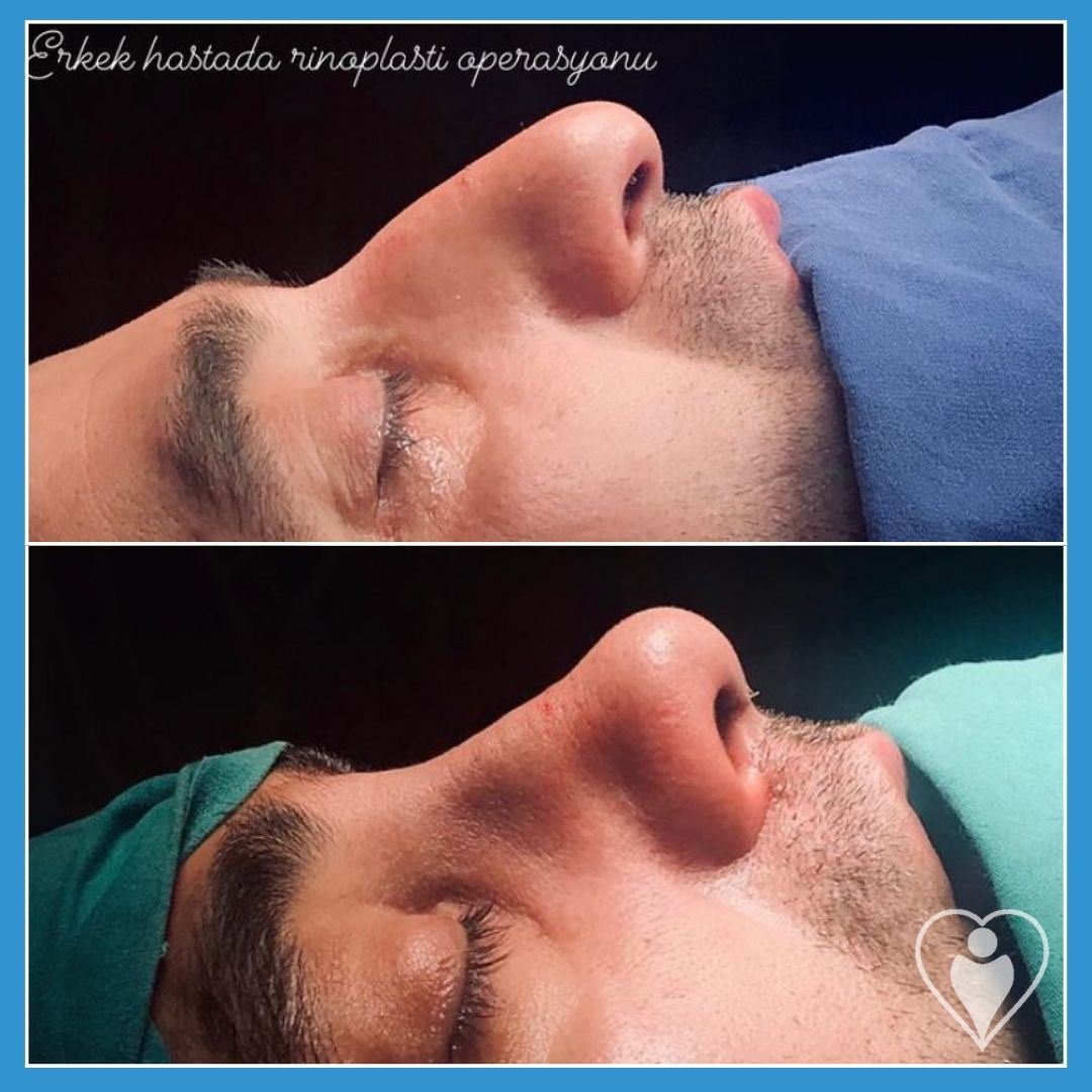 Rhinoplasty, before and after, Luna Clinic Turkey
