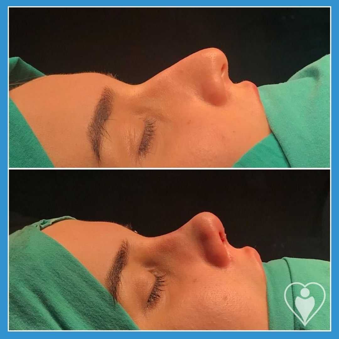 Rhinoplasty, before and after, Luna Clinic Turkey