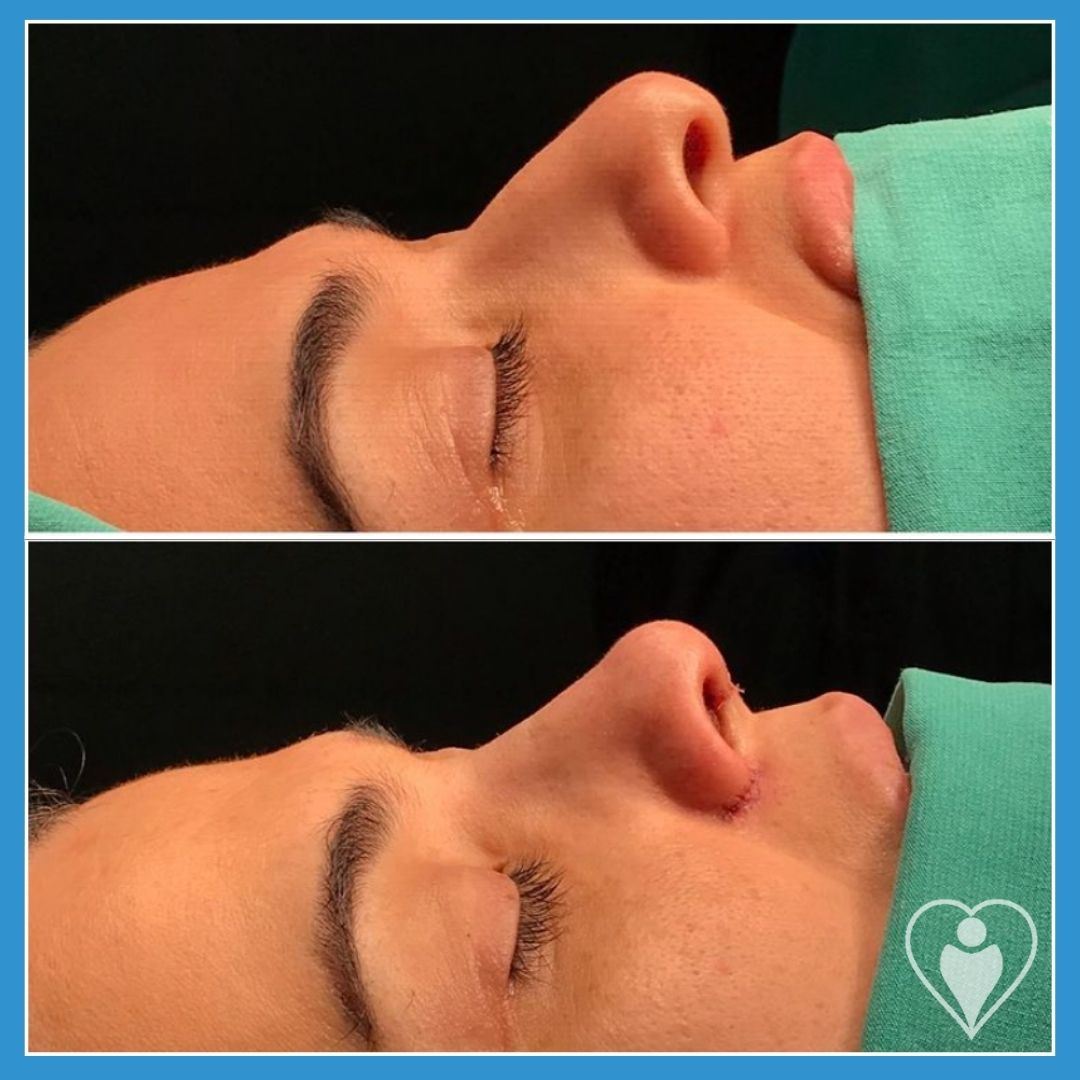 Rhinoplasty, before and after, Luna Clinic Turkey