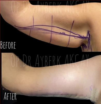 Arm Lift at Dr. Ayberk Akcay Clinic