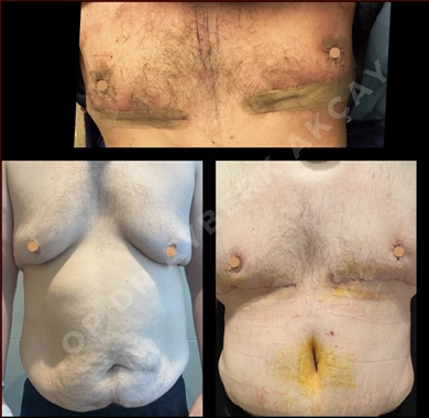 Tummy Tuck at Dr. Ayberk Akcay Clinic