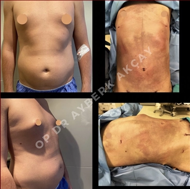 Tummy Tuck at Dr. Ayberk Akcay Clinic
