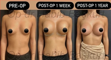 Breast implants, before and after, Dr. Habib Baskurt Clinic