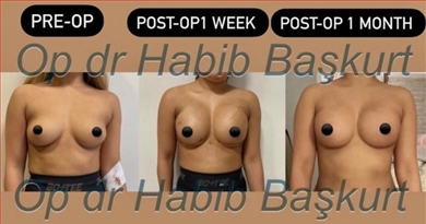 Breast implants, before and after, Dr. Habib Baskurt Clinic