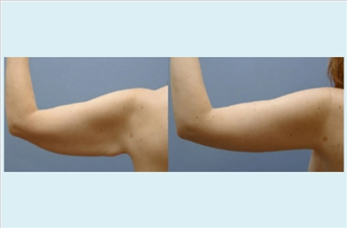 Arm Lift at Dr. Ozge Ergun Plastic Surgery Clinic