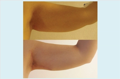 Arm Lift at Dr. Ozge Ergun Plastic Surgery Clinic