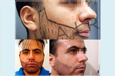 Beard Transplant at Lifemed Medical Center
