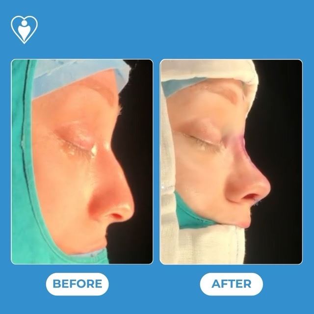 Rhinoplasty, before and after, Luna Clinic Turkey