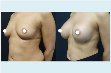 Breast Implants at Dr. Ozge Ergun Plastic Surgery Clinic
