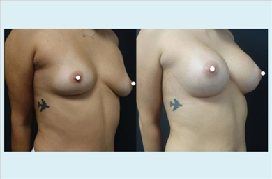 Breast Implants at Dr. Ozge Ergun Plastic Surgery Clinic