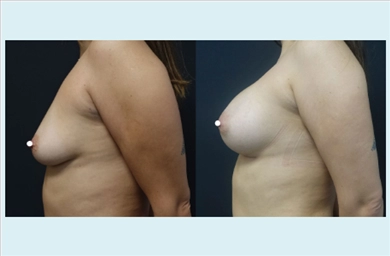 Breast Implants at Dr. Ozge Ergun Plastic Surgery Clinic