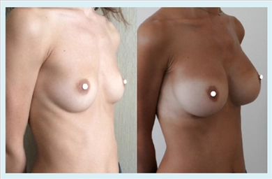 Breast Implants at Dr. Ozge Ergun Plastic Surgery Clinic