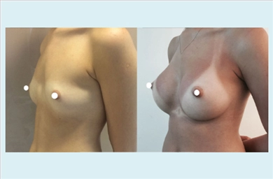 Breast Implants at Dr. Ozge Ergun Plastic Surgery Clinic