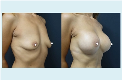 Breast Implants at Dr. Ozge Ergun Plastic Surgery Clinic