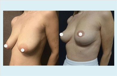 Breast Lift at Dr. Ozge Ergun Plastic Surgery Clinic