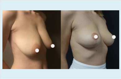 Breast Lift at Dr. Ozge Ergun Plastic Surgery Clinic