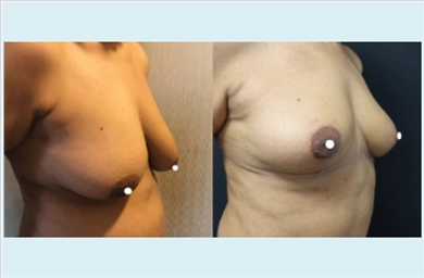 Breast Lift at Dr. Ozge Ergun Plastic Surgery Clinic