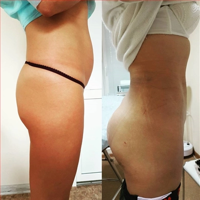 Before and after Plastic surgery at ADONIS Medical Group of Companies