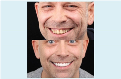 Crowns at DentGroup
