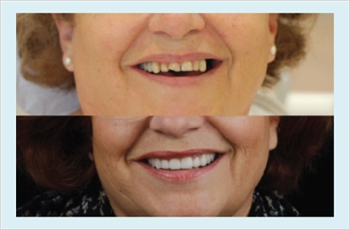 Crowns at DentGroup