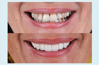 Crowns at DentGroup