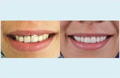 Crowns at DentGroup