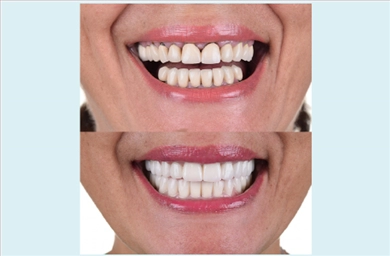 Crowns at DentGroup
