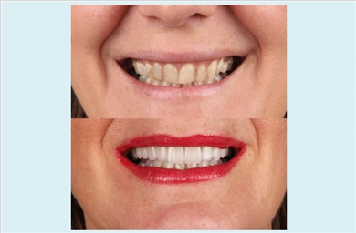 Crowns at DentGroup