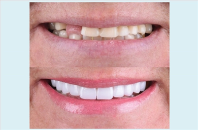 Crowns at DentGroup